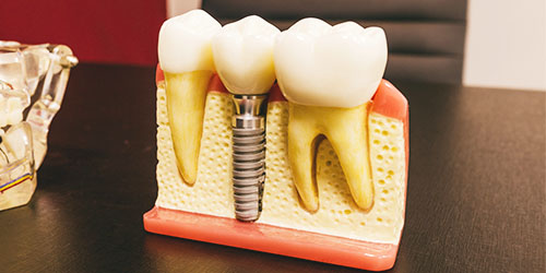 ようこう歯科の歯が抜けた場合の治療の説明(インプラント)