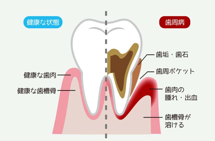 歯の断面イラスト。歯垢・歯石、歯周ポケット、歯肉の腫れ・出血、歯槽骨が溶ける説明。また、健康な歯肉、健康な歯槽骨を右のイラストと左のイラストで比較説明している。