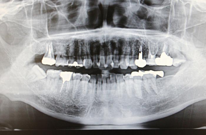 歯根破折・レントゲンイメージ