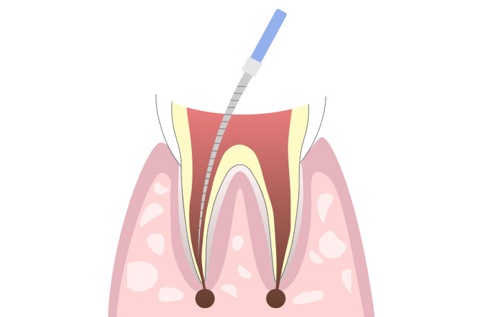 歯の根幹治療イメージ