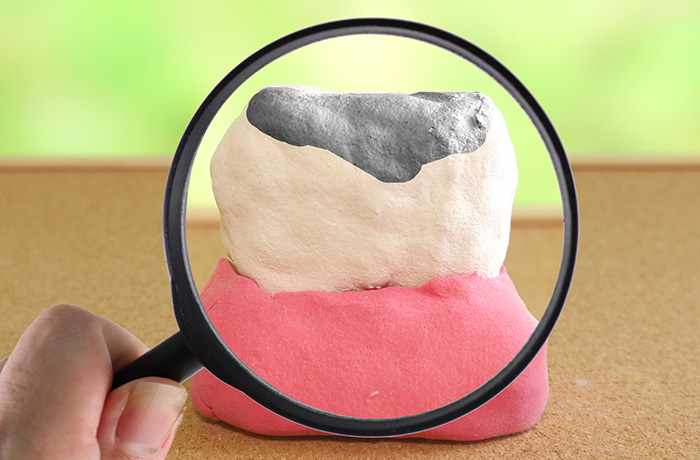 虫歯の模型の写真