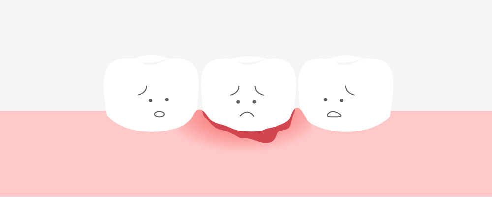 ようこう歯科の歯ぐきから出血する原因の解説